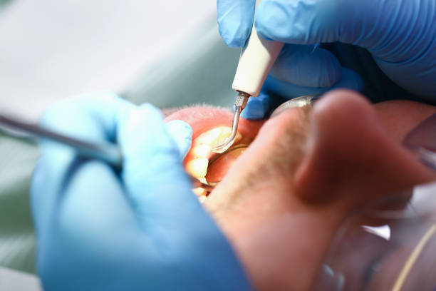 Best Knocked-Out Tooth (Avulsed Tooth) Treatment in Pearisburg, VA